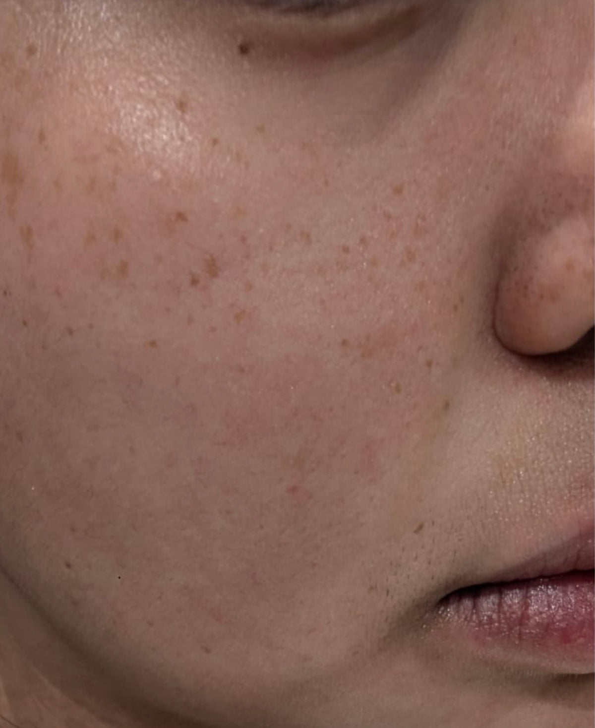 Reactive Skin, 12-Week Programme — before