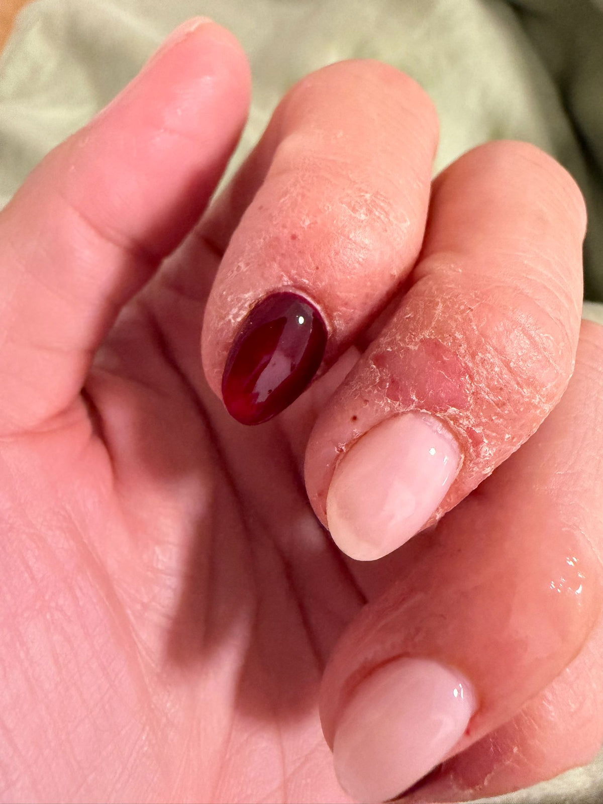 Reactive Skin, 8-Week Programme — before
